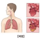 폐렴간균(크레브시엘라)에 의한 폐렴 (Klebsiella pneumoniae infection) 이미지