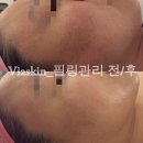 비아스킨