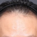 M병원 | 길음동 탈모병원 후기, M자탈모와 두피 비침 진단 후 치료 과정 기록
