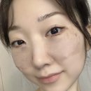 역삼오늘약국 | [ 강남 역삼 ] 눈밑지방재배치 - 내돈내산 솔직 후기 ( 1주일 한달후기 ) 통증 멍 붓기 만족도