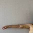 박복분 | 내돈내산 후기, 신논현 라비체의원 지방흡입 + 거상 받은 ssul 푼다 (수술당일~5일간 기록)