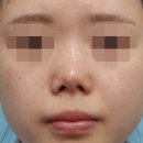 하나비의원 | 구축코성형 후기 통해서 하나비 코재수술 과정 알아보기