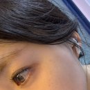 제일한의원 | 화접몽한의원 강남본점 편평사마귀 제거 후기 🍀