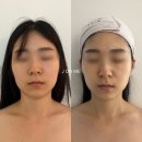 제이온메디칼 | 울산 안면비대칭 교정 제이온미에스테틱