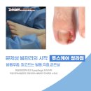 청라문제성발톱 푸스케어청라점에서 해결