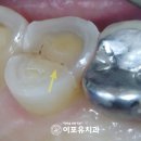 이포유치과의원 | 오산역 치과 치아 실금 (크랙) 방치하면? 결국 수직 치근 파절(Vertical root fracture)로.. 임플란트...