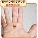 손 혈자리 수지요법 | 방아쇠수지 증후군 수술 1년 후 솔직 후기