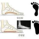 걸을때 발바닥 통증이 있을때 (앞쪽, 가운데, 아치부위 ) 이미지