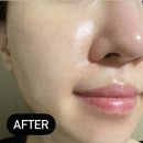 [review]옥길동 피부과, 삼성새봄피부과의원 리쥬란HB플러스 내돈내산 리얼후기.
