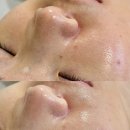 문현2동건강생활지원센터 | 서면 에스테틱 모공 블랙헤드 관리 피부피티센터 세멘시트 후기