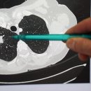 Cancer : en 2050, le nombre de nouveaux cas aura augmenté de 77% par rappor 이미지