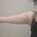 다시내보 | 강남 다이어트병원 제로컷주사 4회차 팔뚝 라인 많이 달라진 후기