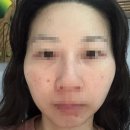 인디자인 | 포항 피부관리 이동 인디자인페이스 링클톡신 필 테라피 후기