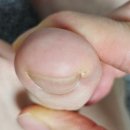 레푸스계양 | 계산동 파고드는 발톱, 내성발톱 관리 후기(포도픽스) : 레푸스 계양구청점(내성발톱원인)