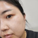 532 | 주근깨 없애는 방법 : 피코 532 레이저 시술 후기, 효과, 정리