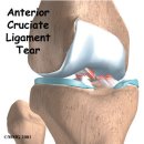 전방십자인대 손상(Anterior Cruciate Ligament Injuries) 무릎 손상 이미지