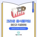 경희대학교 치의학전문대학원 | 여주치과잘하는곳 보철치료 후 음식물 끼임 현상 해결하는 법