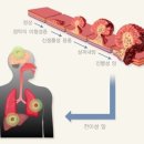 대장용종 &amp; 선종 이미지