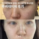 두드림약국 - 수원시 팔달구 일월로22번길 15 | 주근깨 없애는 법 압구정 루나의원 루비레이저 후기 통증 일주일 경과후기