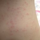 땀띠..? 아토피..?? (사진有)제발 좀 봐주셔요...ㅜㅜ 이미지