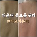 부산 해운대 등드름 관리 더모어뷰티에서 효과본 후기
