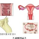 성병 증상 남자 여자 성병종류 매독 검사 이미지