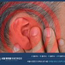 서울에이블이비인후과 네이버블로그