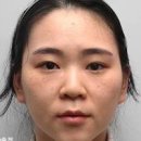 실리프팅 효과 얼굴처짐 윤곽개선 팔자주름 개선 이미지