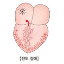 부정맥(Cardiac arrhythmias) 이미지