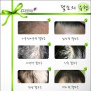 [의왕피부과추천]"산후탈모"고통 탈출방법!!(여성탈모 치료방법) 이미지