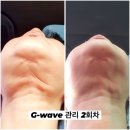 디엔피 컨설팅 | 안면거상 고주파 글러브 리프팅 지웨이브(G-WAVE)를 강력 추천!!! 구매 상담 및 전국 데모 문의 환영