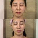 트리플프라자 | [수원 영통 피부관리 포이에마피부샵] 트리플3콤보리프팅 받고 얼굴선이 달라졌다 찐 후기