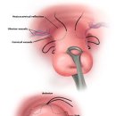 자궁경관무력증 [Incompetent internal os of cervix] 이미지