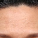 서울동구로초등학교 | 구로구피부과 이마·미간 보톡스 후기｜부작용 걱정부터 경과 확인까지