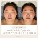 안경114앤뷰티샵 | 결앤핏 슈퍼젝션 관리 후기｜통증·다운타임·관리전후차이