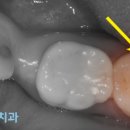 이하루치과 네이버블로그