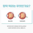 부산성모안과병원 | 해운대 부산성모안과병원 응급 망막박리 수술 1인실 입원 시설 및 비용 후기