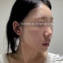 달한조각 | 코조각주사 한달 후기 (코는 왜 나이들수록 커질까?)