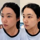 올핸드피스 주식회사 | 강남역피부과 올타이트리프팅 200샷 솔직후기 (울쎄라와 차이점, 통증)
