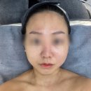 소사피부관리 잘하는곳 뷰티새로움에서 물방울리프팅 후기