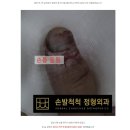 손가락 개방 골절. 삼일병원 입원 후기