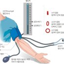 저혈압(hypotension) 이미지