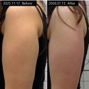 서울S한의원 | 위팔 리프팅 효과 좋을까? 아크로웨이브 위팔 시술 아크로한의원 후기!