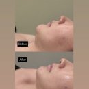 무교로 | 광화문피부관리 뷰태에스테틱 윤곽관리 하이푸리프팅 후기