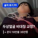 수한의원 | 안면비대칭 고칠 수 있을까? + 온다 리프팅 후기 | 강남 한의원