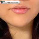 한티역 피부과 입술필러 후기 1cc 가격 통증 주의사항 유지기간