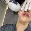 튠페이스 내돈내산 후기/눈가입가 잔주름후기/처진불독살,심부볼 리프팅후기/얀클리닉을 선택한 이유