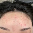 룩스웰의원 | [내돈내산] 청주 여드름치료 ３회차 룩스웰의원 솔직 후기