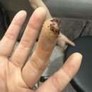 뉴삼성약국 | 고구마 썰다 손가락 썬 후기 : 응급실 손가락 봉합 후기