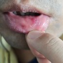 (보령컨슈머헬스케어) 입병 구내염 치료제 알보큐액 사용후기_사진주의